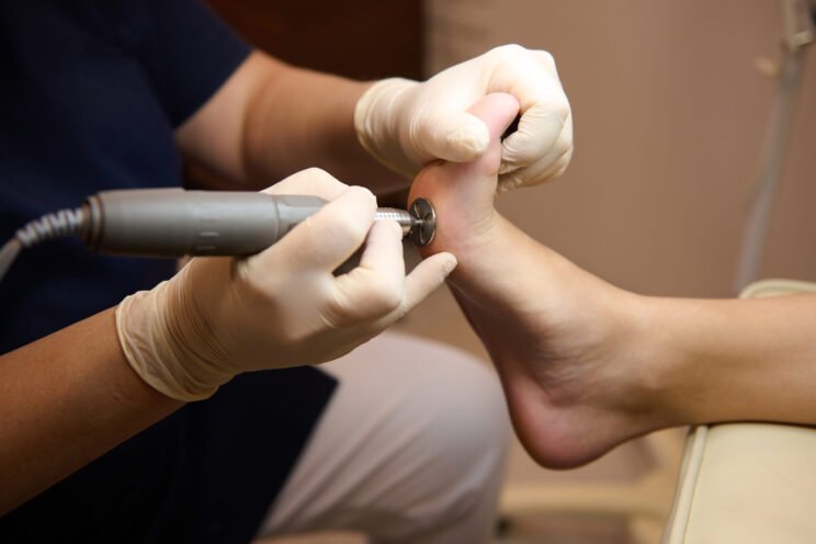 Close-up of a patient on medical pedicure procedure, visiting podiatrist, receiving hardware peeling procedure with electric machine