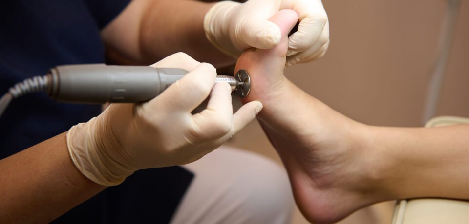 Close-up of a patient on medical pedicure procedure, visiting podiatrist, receiving hardware peeling procedure with electric machine