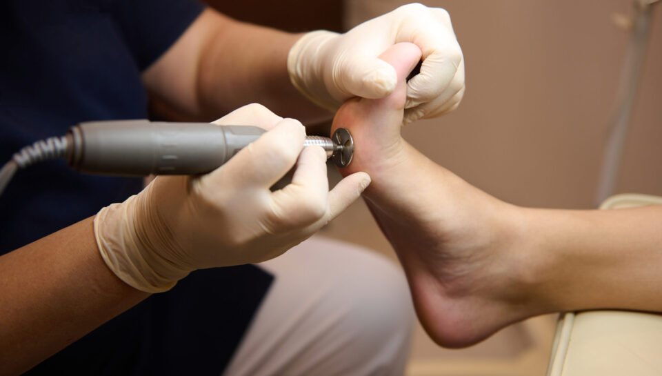 Close-up of a patient on medical pedicure procedure, visiting podiatrist, receiving hardware peeling procedure with electric machine